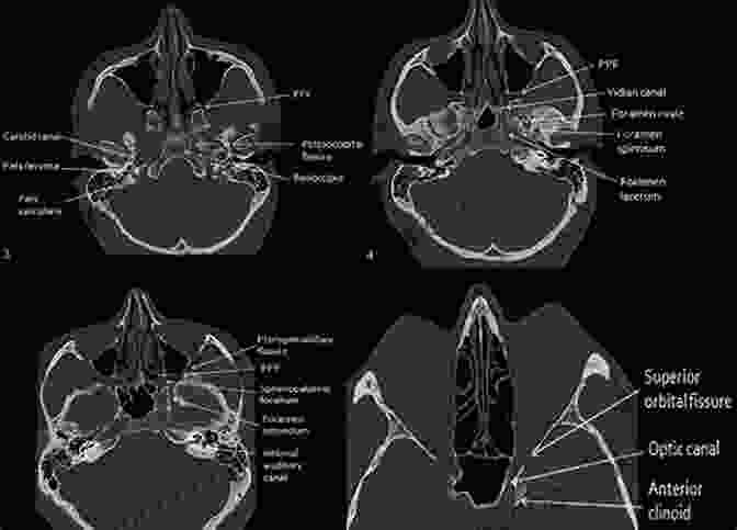 CT Scan Of The Skull Base Skull Base Neuroimaging An Issue Of Neuroimaging Clinics Of North America E (The Clinics: Internal Medicine)