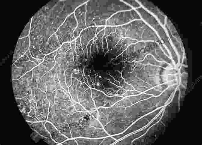 Fluorescein Angiogram Of Diabetic Retinopathy Ophthalmology: Current And Future Developments Volume 2: Diagnostic Atlas Of Retinal Diseases