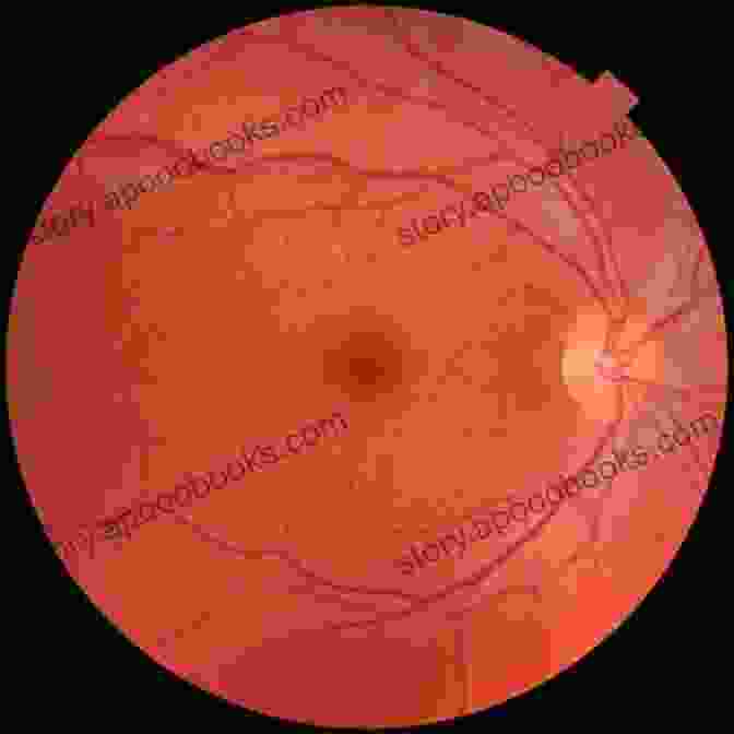 Fundus Photograph Of A Healthy Retina Ophthalmology: Current And Future Developments Volume 2: Diagnostic Atlas Of Retinal Diseases