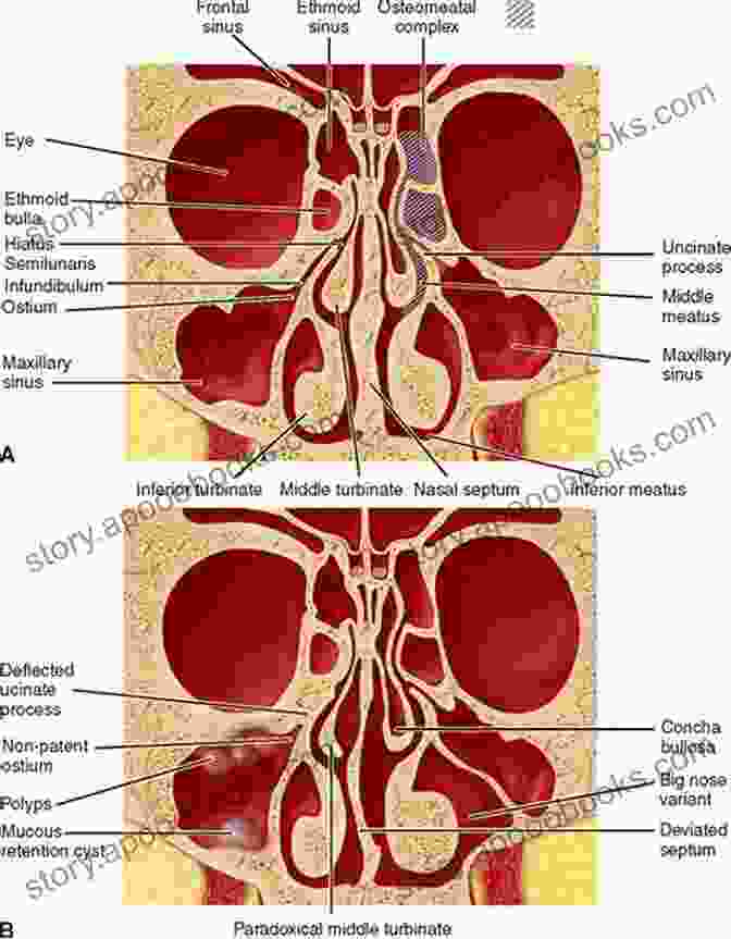 Nasal Cavity And Paranasal Sinuses Anatomy Clinical Anatomy Of The Nose Nasal Cavity And Paranasal Sinuses