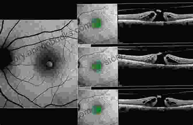 OCT Image Of A Macular Hole Ophthalmology: Current And Future Developments Volume 2: Diagnostic Atlas Of Retinal Diseases