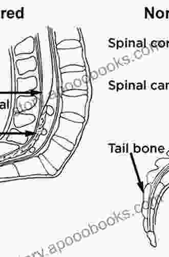 Tethered Cord Syndrome In Children And Adults