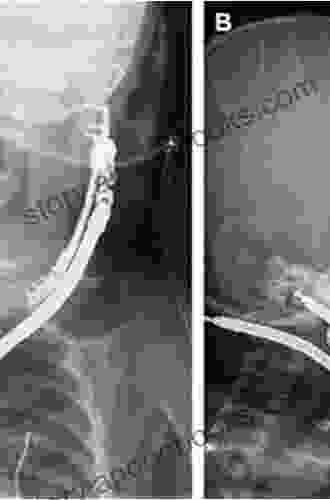 Craniofacial Distraction An Issue Of Clinics In Plastic Surgery E (The Clinics: Surgery 48)